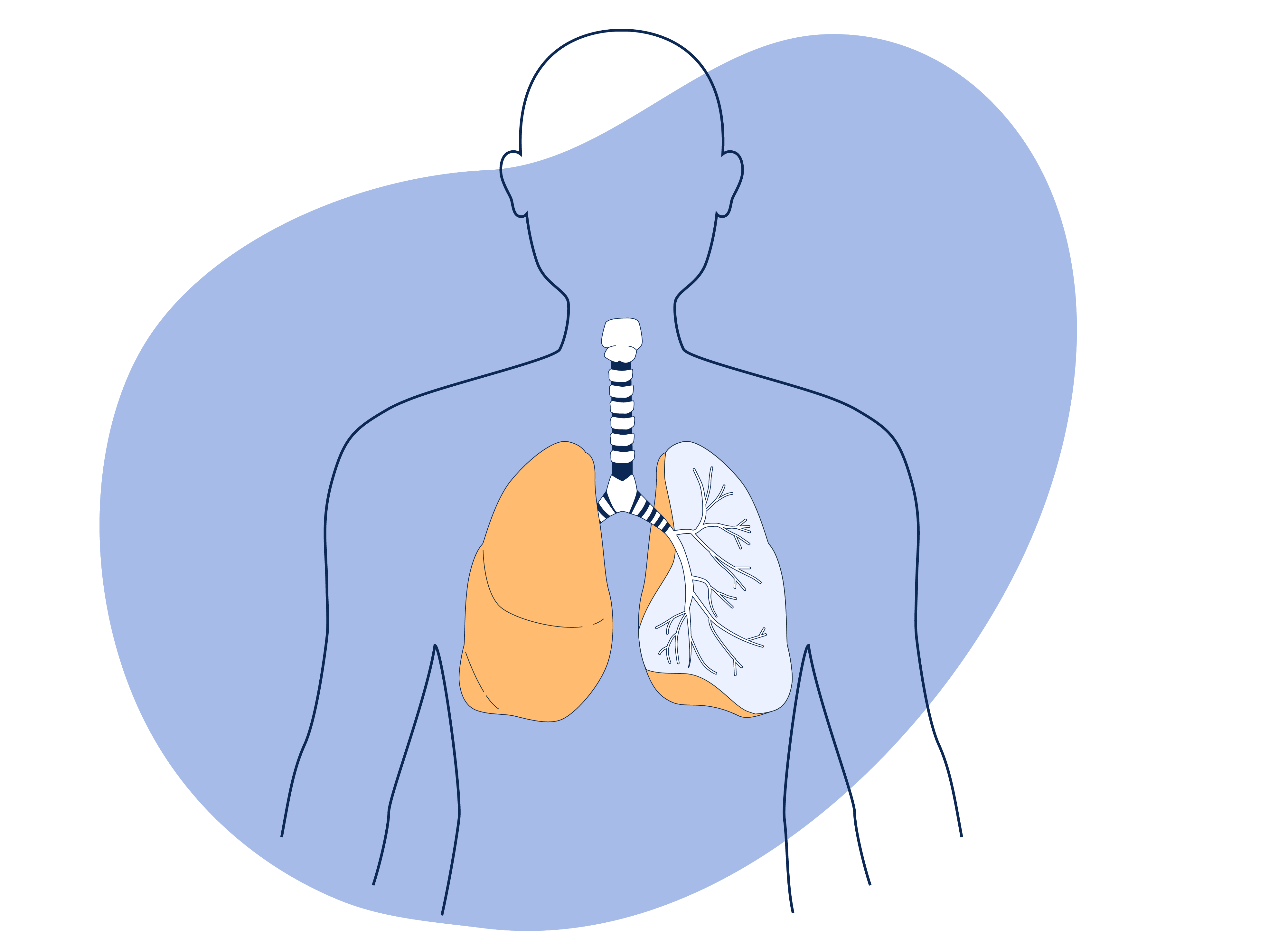 Apparato respiratorio e alfa 1 at - Deficit di Alfa 1 At Antitripsina